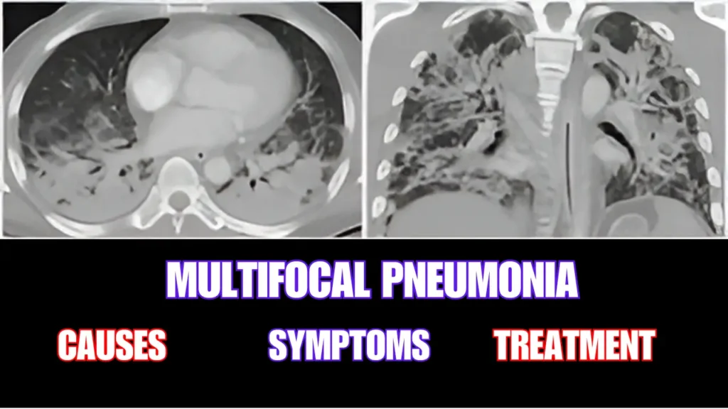 Multifocal Pneumonia Symptoms, Causes, and Treatment